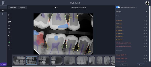 overjet