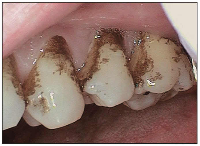 Figure 5. This patient has been seen on 3-month intervals for an extended period of time. Each time, he presented with a heavy amount of stain due to his diet. The patient is not a tobacco user.