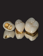 Argen - Crowns and Bridges - Dentistry Today